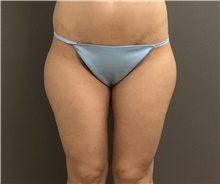 Liposuction Before Photo by Keshav Magge, MD; Bethesda, MD - Case 39404