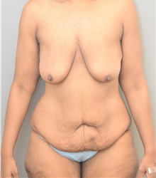 Tummy Tuck Before Photo by Keshav Magge, MD; Bethesda, MD - Case 39407