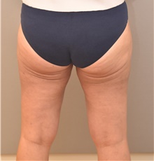 Liposuction After Photo by Keshav Magge, MD; Bethesda, MD - Case 39495
