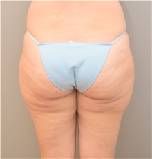 Liposuction Before Photo by Keshav Magge, MD; Bethesda, MD - Case 39495