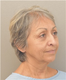 Facelift Before Photo by Keshav Magge, MD; Bethesda, MD - Case 39540
