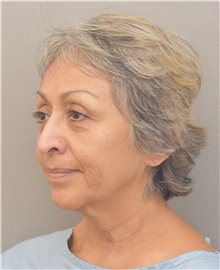 Facelift Before Photo by Keshav Magge, MD; Bethesda, MD - Case 39540