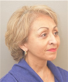 Neck Lift After Photo by Keshav Magge, MD; Bethesda, MD - Case 39541