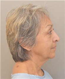 Neck Lift Before Photo by Keshav Magge, MD; Bethesda, MD - Case 39541
