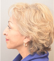 Neck Lift After Photo by Keshav Magge, MD; Bethesda, MD - Case 39541