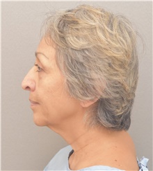 Neck Lift Before Photo by Keshav Magge, MD; Bethesda, MD - Case 39541