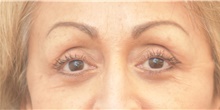 Eyelid Surgery After Photo by Keshav Magge, MD; Bethesda, MD - Case 39542