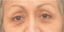 Eyelid Surgery Before Photo by Keshav Magge, MD; Bethesda, MD - Case 39542