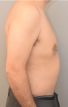 Male Breast Reduction After Photo by Keshav Magge, MD; Bethesda, MD - Case 39543