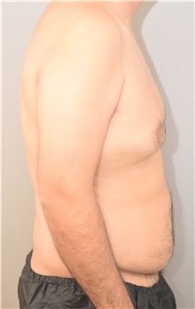 Male Breast Reduction Before Photo by Keshav Magge, MD; Bethesda, MD - Case 39543