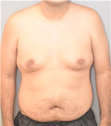 Tummy Tuck Before Photo by Keshav Magge, MD; Bethesda, MD - Case 39544