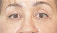 Eyelid Surgery After Photo by Keshav Magge, MD; Bethesda, MD - Case 39545