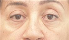 Eyelid Surgery Before Photo by Keshav Magge, MD; Bethesda, MD - Case 39545