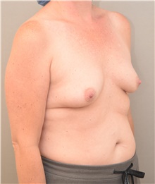 Breast Augmentation Before Photo by Keshav Magge, MD; Bethesda, MD - Case 39546