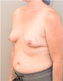 Breast Augmentation Before Photo by Keshav Magge, MD; Bethesda, MD - Case 39546