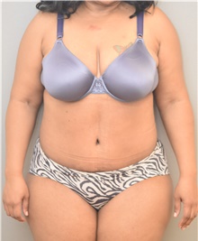 Tummy Tuck After Photo by Keshav Magge, MD; Bethesda, MD - Case 39547