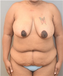 Tummy Tuck Before Photo by Keshav Magge, MD; Bethesda, MD - Case 39547