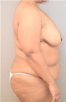 Tummy Tuck Before Photo by Keshav Magge, MD; Bethesda, MD - Case 39547