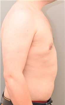 Male Breast Reduction After Photo by Keshav Magge, MD; Bethesda, MD - Case 39556