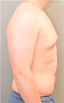 Male Breast Reduction Before Photo by Keshav Magge, MD; Bethesda, MD - Case 39556