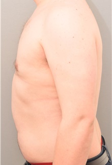 Male Breast Reduction After Photo by Keshav Magge, MD; Bethesda, MD - Case 39556