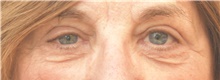 Eyelid Surgery After Photo by Keshav Magge, MD; Bethesda, MD - Case 39557