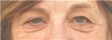 Eyelid Surgery Before Photo by Keshav Magge, MD; Bethesda, MD - Case 39557