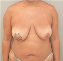 Breast Lift Before Photo by Keshav Magge, MD; Bethesda, MD - Case 39558