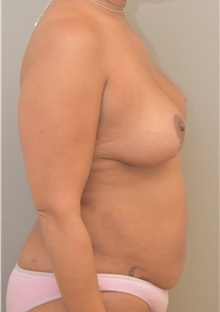 Breast Lift After Photo by Keshav Magge, MD; Bethesda, MD - Case 39558