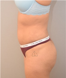 Buttock Lift with Augmentation After Photo by Keshav Magge, MD; Bethesda, MD - Case 39569