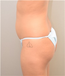Buttock Lift with Augmentation Before Photo by Keshav Magge, MD; Bethesda, MD - Case 39569