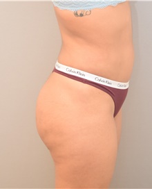 Liposuction After Photo by Keshav Magge, MD; Bethesda, MD - Case 39571
