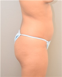 Liposuction Before Photo by Keshav Magge, MD; Bethesda, MD - Case 39571