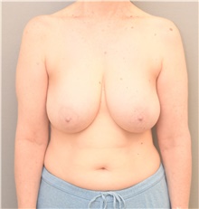 Breast Reduction Before Photo by Keshav Magge, MD; Bethesda, MD - Case 39583