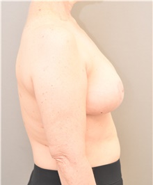 Breast Reduction After Photo by Keshav Magge, MD; Bethesda, MD - Case 39583