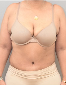 Tummy Tuck After Photo by Keshav Magge, MD; Bethesda, MD - Case 39585