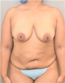 Tummy Tuck Before Photo by Keshav Magge, MD; Bethesda, MD - Case 39585