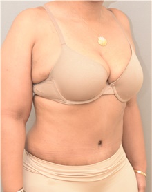 Tummy Tuck After Photo by Keshav Magge, MD; Bethesda, MD - Case 39585