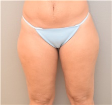 Liposuction Before Photo by Keshav Magge, MD; Bethesda, MD - Case 39586
