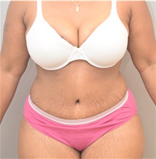 Tummy Tuck After Photo by Keshav Magge, MD; Bethesda, MD - Case 39638