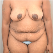 Tummy Tuck Before Photo by Keshav Magge, MD; Bethesda, MD - Case 39638