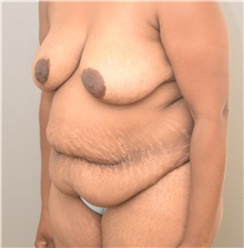 Tummy Tuck Before Photo by Keshav Magge, MD; Bethesda, MD - Case 39638
