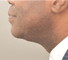 Chin Augmentation After Photo by Keshav Magge, MD; Bethesda, MD - Case 39639