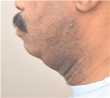 Chin Augmentation Before Photo by Keshav Magge, MD; Bethesda, MD - Case 39639
