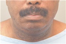 Chin Augmentation Before Photo by Keshav Magge, MD; Bethesda, MD - Case 39639