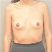 Breast Augmentation Before Photo by Keshav Magge, MD; Bethesda, MD - Case 41622