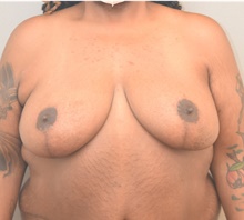 Breast Reduction After Photo by Keshav Magge, MD; Bethesda, MD - Case 41766