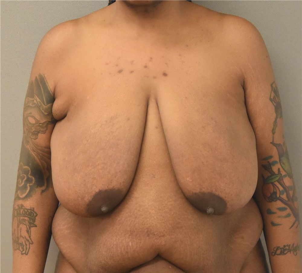 Body Contouring Before and After Photos by Keshav Magge, MD; Bethesda, MD -  Case 38640