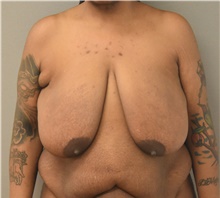 Breast Reduction Before Photo by Keshav Magge, MD; Bethesda, MD - Case 41766