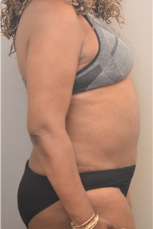 Tummy Tuck After Photo by Keshav Magge, MD; Bethesda, MD - Case 41777